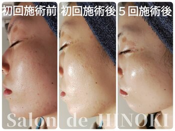サロン ド ヒノキ(Salon de HINOKI)/水光肌☆ハーブピーリング