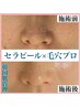【韓国肌管理☆本気の毛穴改善セット】毛穴プロ×セラピール　27500→19800
