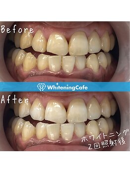 ホワイトニングカフェ 相模大野店(WhiteningCafe)/【ビフォーアフター】2回
