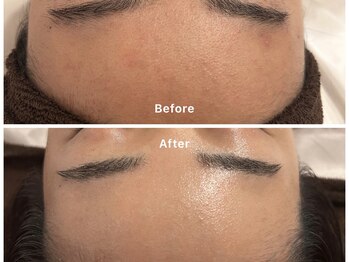 サロンアルーナ(Salon a Luna)/剥離なしハーブピーリング