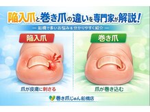 巻き爪じゅん 千葉駅前店/巻き爪の違いを専門家が解説