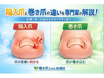 巻き爪じゅん 千葉駅前店/巻き爪の違いを専門家が解説