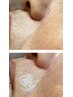 【部分Wax】 口周りorおでこor鼻