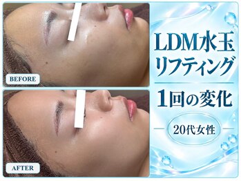 モアナ(MOANA)/LDM水玉リフティング