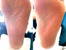 ハッチネイル(HACCI nail)