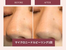 セレブヒルズ 札幌本店(Celeb Hill's)の雰囲気（毛穴・角質を天然鉱石ゴッソリ大掃除！ニキビケアにもオススメ◎）