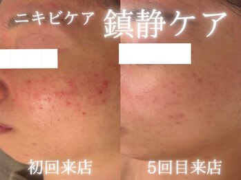 アールエーサロン 恵比寿 広尾(Ra salon)/5回でのニキビ変化!