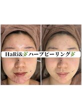 ハリト エステ(HaRi&)/毛穴洗浄/熊本/ハーブピーリング