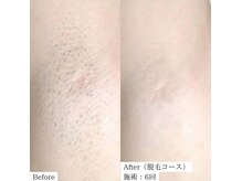 ミレ(mirae)の雰囲気（当サロンのマシンの光は脱毛の効果もすごい◎）