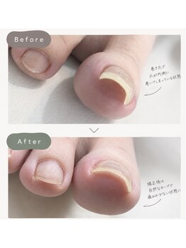 ネイルホーラー(Nail-HAULER)の写真/巻き爪でも可愛いを楽しみたい貴方へ。熟練の技術で理想の可愛い指先をサポート◎
