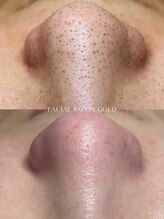 ゴールド 恵比寿店(GOLD)/【毛穴エクストラクション】