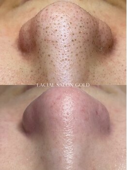 ゴールド 恵比寿店(GOLD)/【毛穴エクストラクション】