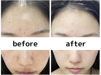 ビューティーサロン リリー(Lily)/シリカピーリング★ニキビケア