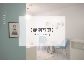 ベル 北千住(Belle)/ハーブピーリング|Before After