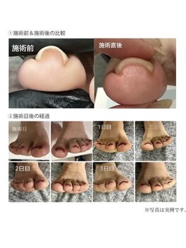 リリー(Lilly)/巻き爪矯正