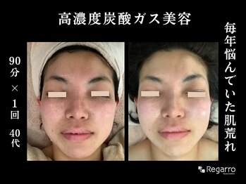 レガロビューティクリエイションズ桜川店/もう悩まない！肌荒れ改善