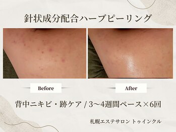 プライベートエステサロン トゥインクル/跡が残りやすい肩まわりのケアに