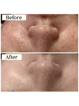 ルアナ 柏店(LUANA)/いちご鼻毛穴改善例