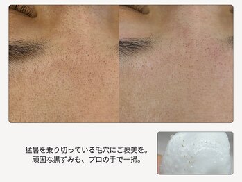 ボーテラボ 大宮(beaute LABO)の写真/夏枯れ肌をリセット！『頑固な毛穴詰まり』、ワックスですっきりオフしませんか？