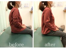 カイロラインメディカル整体 平塚院(Chiro Line)/７０代×猫背矯正 / BeforeAfter