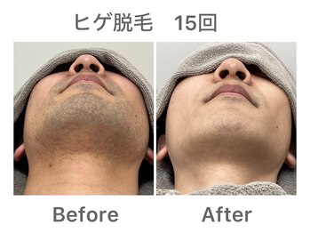 ナルシス/【ヒゲ脱毛】15回の変化★