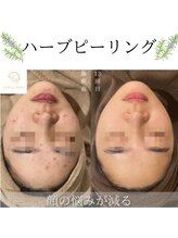 ココロ(COCORO)/ハーブピーリングで美肌を♪