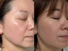 フェリス(FELIZ)/落ちにくいお顔の脂肪はお任せ