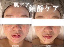 アールエーサロン 恵比寿 広尾(Ra salon)/鎮静ケア