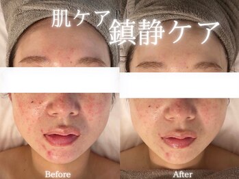 アールエーサロン 恵比寿 広尾(Ra salon)/鎮静ケア