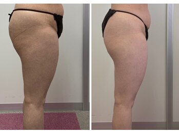 ベル(Belle)/【脂肪よ！おさらば！】脂肪冷却