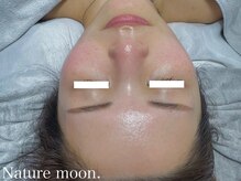 ナチュールムーン(Nature moon.)/ハーブピーリング　 after