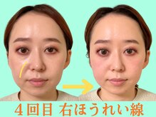 ナチュラルパーフェクトフェイス 新宿/4回目・リフトアップ/新宿小顔