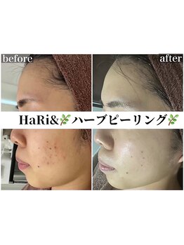 ハリト エステ(HaRi&)/毛穴洗浄/熊本/ハーブピーリング