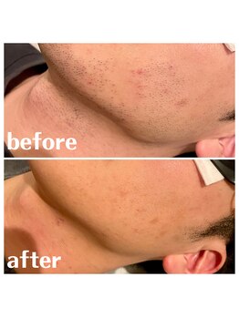 ベイス(BASE)/ヒゲ脱毛BeforeAfter
