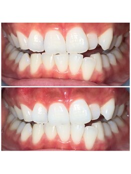 メンズ脱毛 リボーン(reborn)/ネネの歯