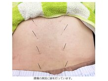 よしだ鍼灸整骨院 整体院/腰部・腰痛に鍼を刺している所