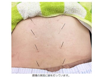 よしだ鍼灸整骨院 整体院/腰部・腰痛に鍼を刺している所