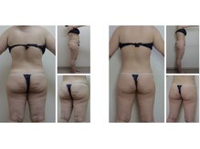 Nビューティー/最新エンダモロジーBODY