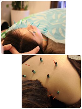 リマホオラシンキュウセイコツイン(lima ho ola鍼灸整骨院)/美容鍼+鍼灸+ヘッドスパ