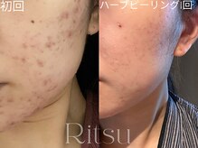 リツ(Ritsu)/ハーブピーリング/ニキビケア/跡