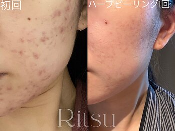 リツ(Ritsu)/ハーブピーリング/ニキビケア/跡