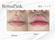 ベラ 東京院(Bella)/看護師施術でメラニン除去