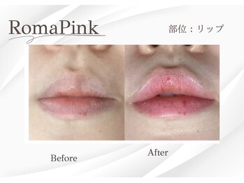 ベラ 東京院(Bella)/看護師施術でメラニン除去