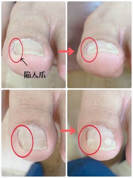 一宮巻き爪センター/陥入爪