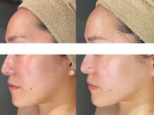 ハナイロ(hana-iro)の雰囲気(艶肌になれる最先端◎低刺激の剥けない肌育ラミネーションピール)