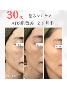 デアマリス/産後しみ 30代前半 大宮エステ