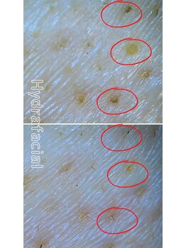 ハーシークレット(Her secret)/ハイドラ毛穴洗浄