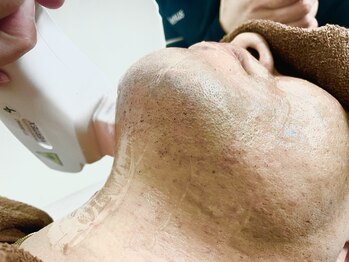 ヴィーナス(Venus)/髭脱毛中のポップアップ現象