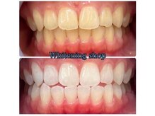 ホワイトニングショップ 天王寺店/40分照射×10回 20代女性