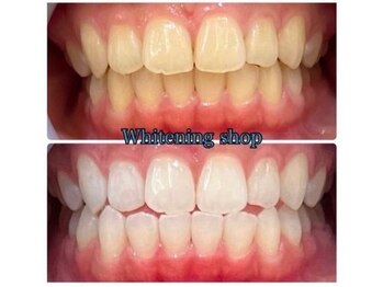 ホワイトニングショップ 天王寺店/40分照射×10回 20代女性